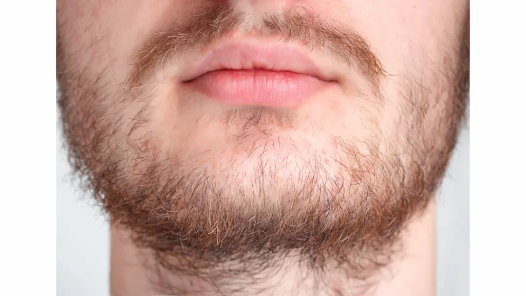 Causas De La Pérdida De Barba