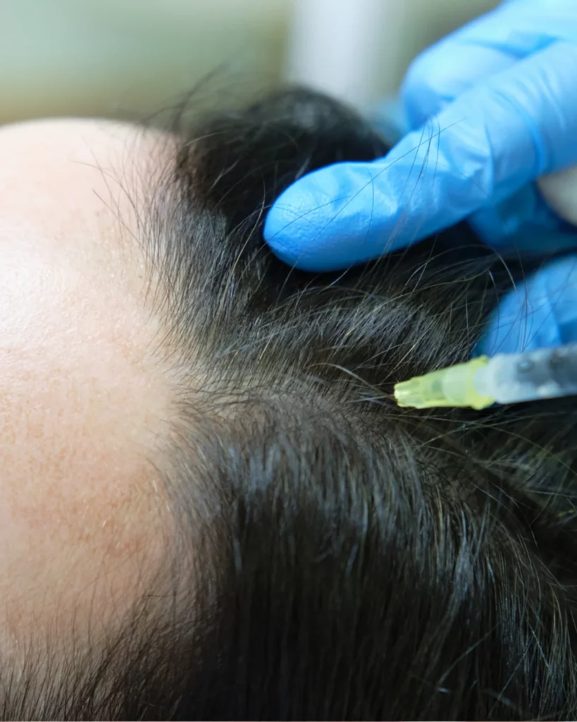 La Mesoterapia Biológica