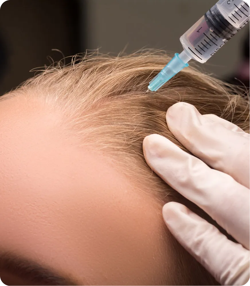 Mesoterapia Capilar Que Es