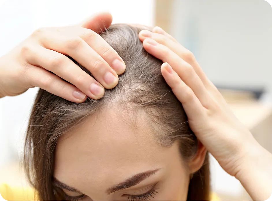 Tipo De Alopecia Mesoterapia Capilar