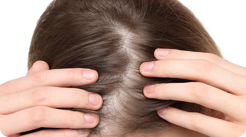 Tipo De Alopecia Regenera Activa